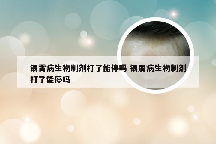 银霄病生物制剂打了能停吗 银屑病生物制剂打了能停吗