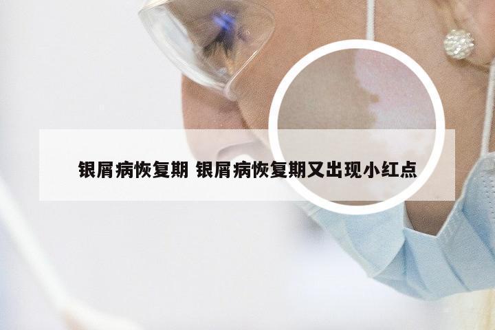 银屑病恢复期 银屑病恢复期又出现小红点