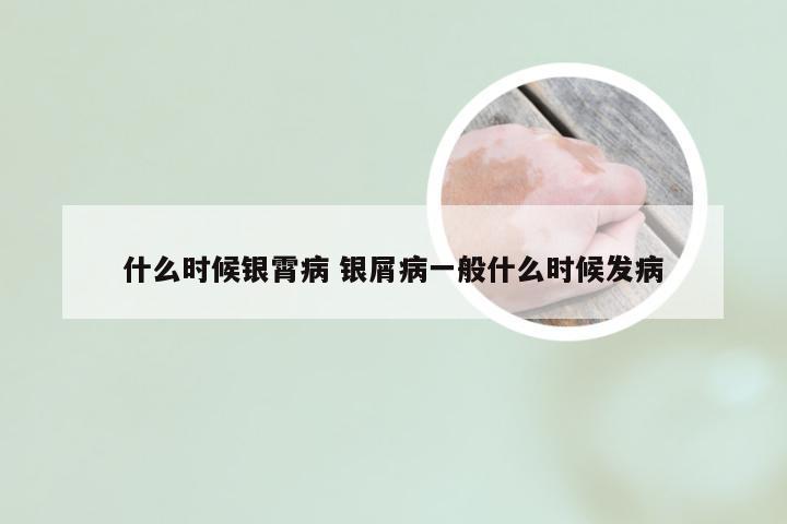 什么时候银霄病 银屑病一般什么时候发病