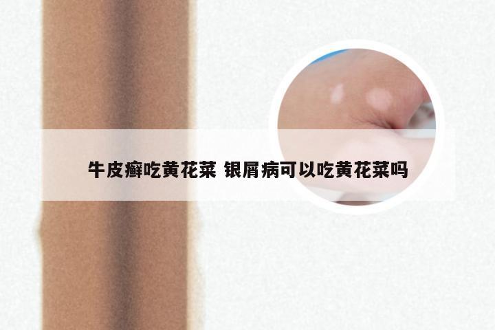 牛皮癣吃黄花菜 银屑病可以吃黄花菜吗