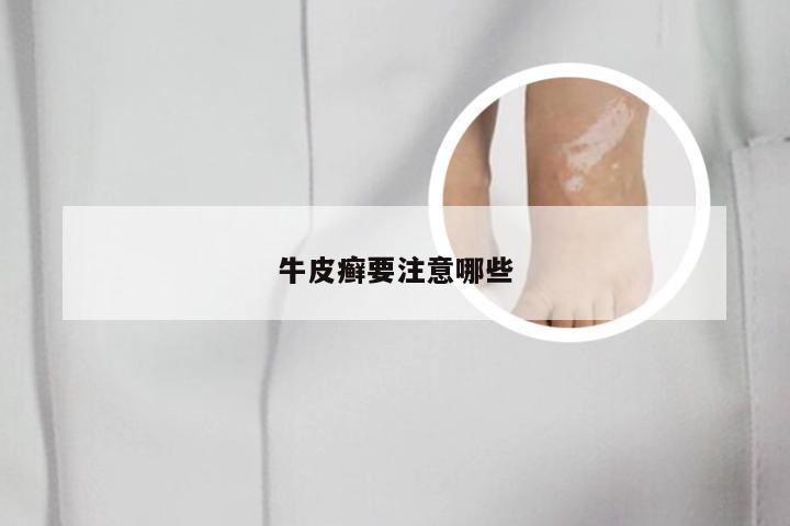 牛皮癣要注意哪些