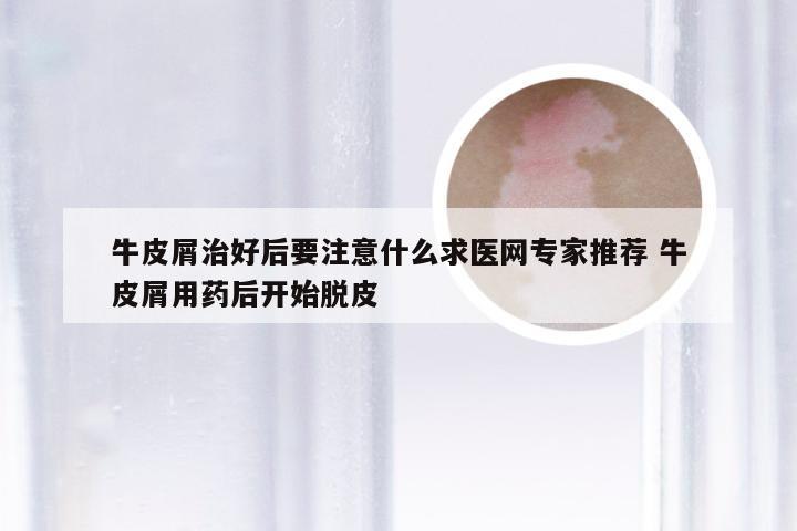牛皮屑治好后要注意什么求医网专家推荐 牛皮屑用药后开始脱皮