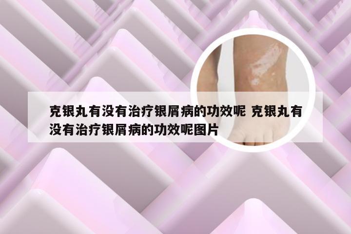 克银丸有没有治疗银屑病的功效呢 克银丸有没有治疗银屑病的功效呢图片
