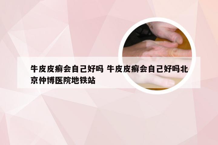 牛皮皮癣会自己好吗 牛皮皮癣会自己好吗北京仲博医院地铁站