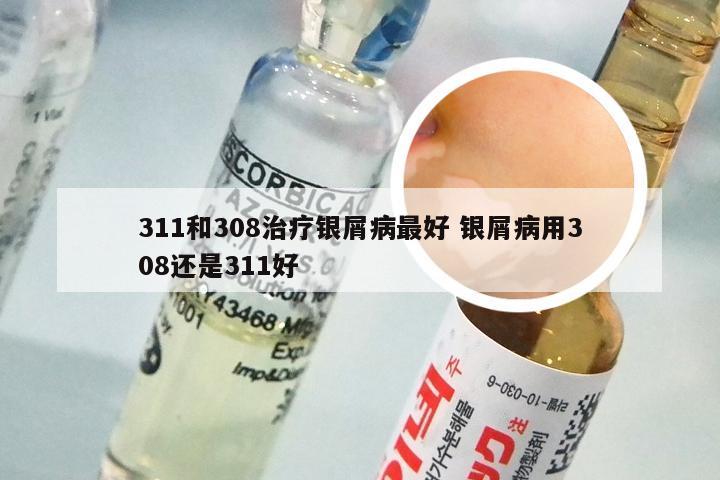 311和308治疗银屑病最好 银屑病用308还是311好