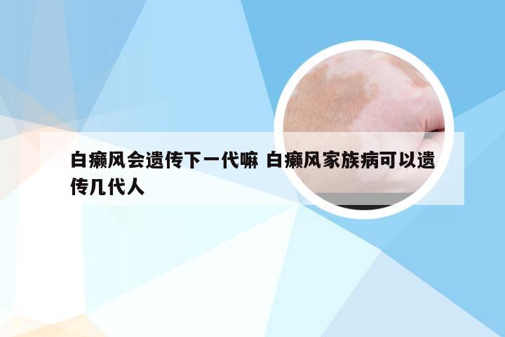 白癞风会遗传下一代嘛 白癞风家族病可以遗传几代人