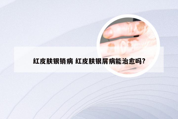 红皮肤银销病 红皮肤银屑病能治愈吗?