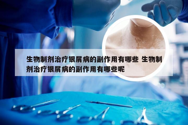 生物制剂治疗银屑病的副作用有哪些 生物制剂治疗银屑病的副作用有哪些呢