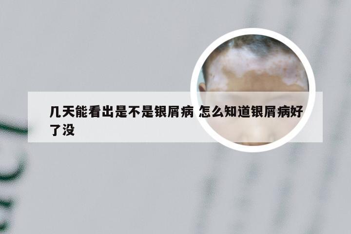 几天能看出是不是银屑病 怎么知道银屑病好了没