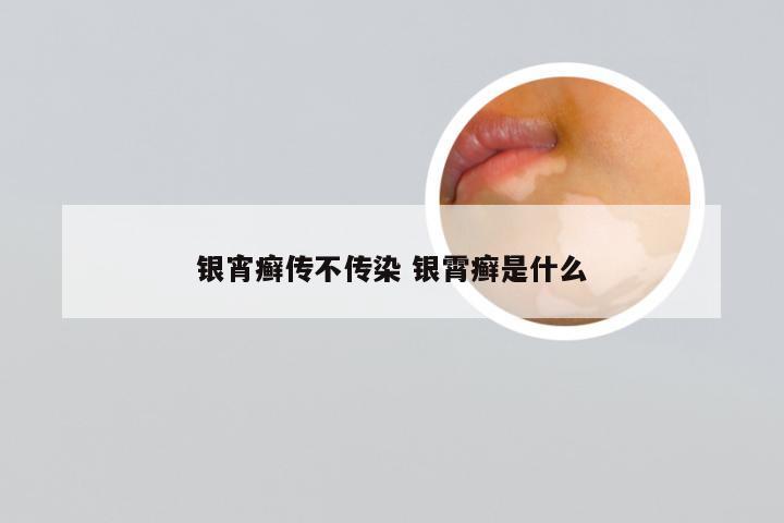 银宵癣传不传染 银霄癣是什么