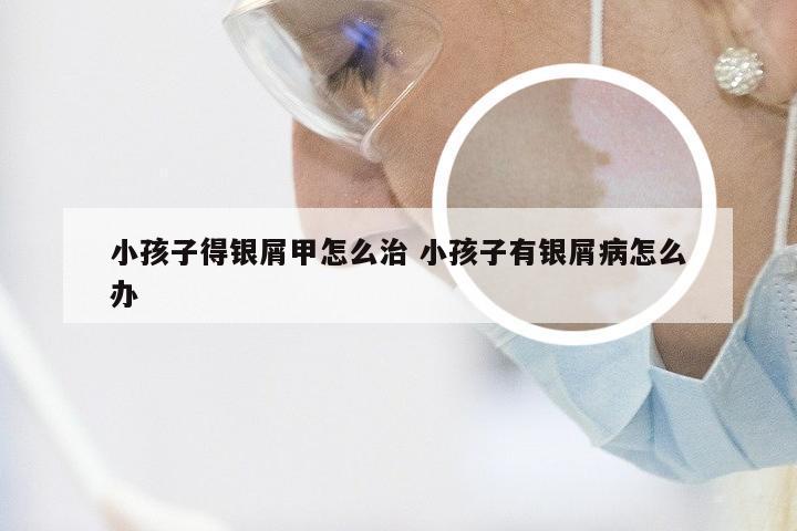 小孩子得银屑甲怎么治 小孩子有银屑病怎么办