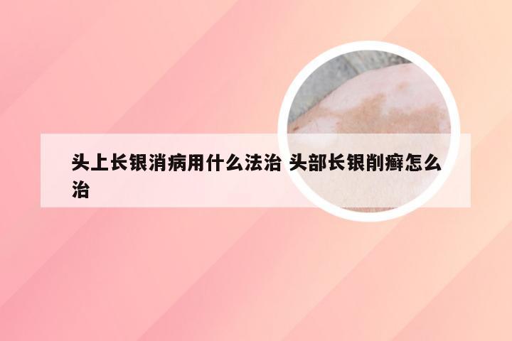 头上长银消病用什么法治 头部长银削癣怎么治