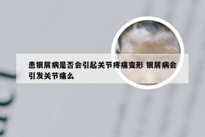 患银屑病是否会引起关节疼痛变形 银屑病会引发关节痛么