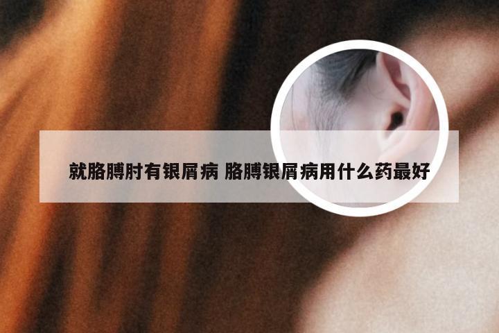 就胳膊肘有银屑病 胳膊银屑病用什么药最好
