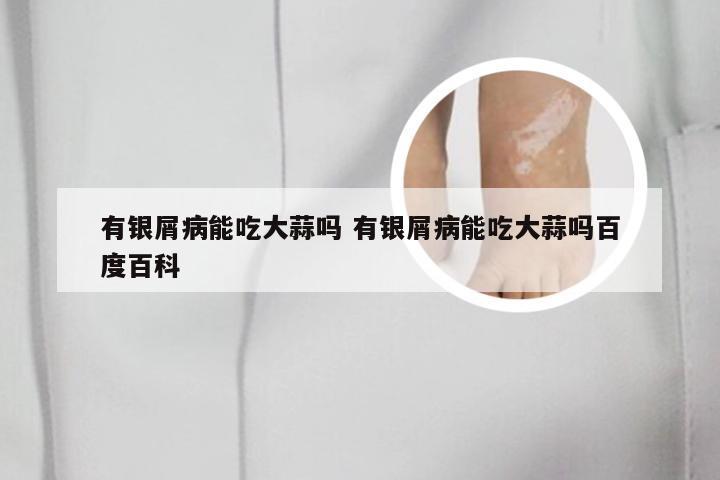 有银屑病能吃大蒜吗 有银屑病能吃大蒜吗百度百科