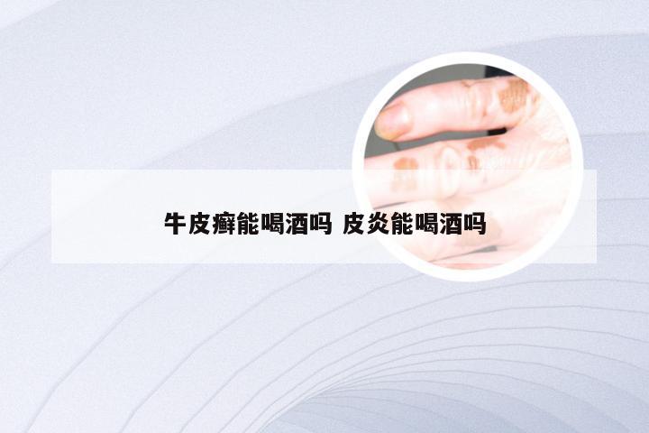 牛皮癣能喝酒吗 皮炎能喝酒吗