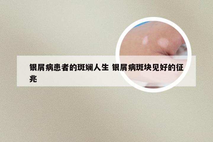 银屑病患者的斑斓人生 银屑病斑块见好的征兆