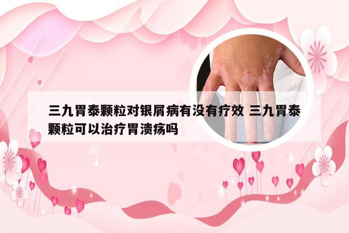 三九胃泰颗粒对银屑病有没有疗效 三九胃泰颗粒可以治疗胃溃疡吗