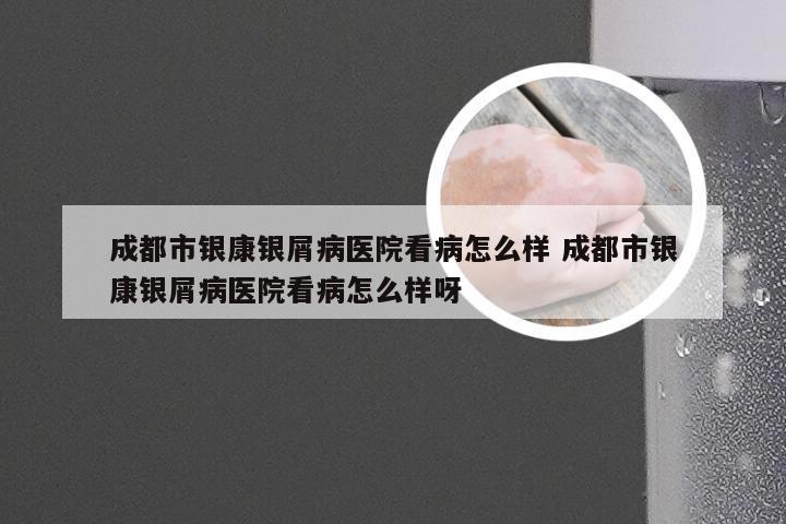 成都市银康银屑病医院看病怎么样 成都市银康银屑病医院看病怎么样呀