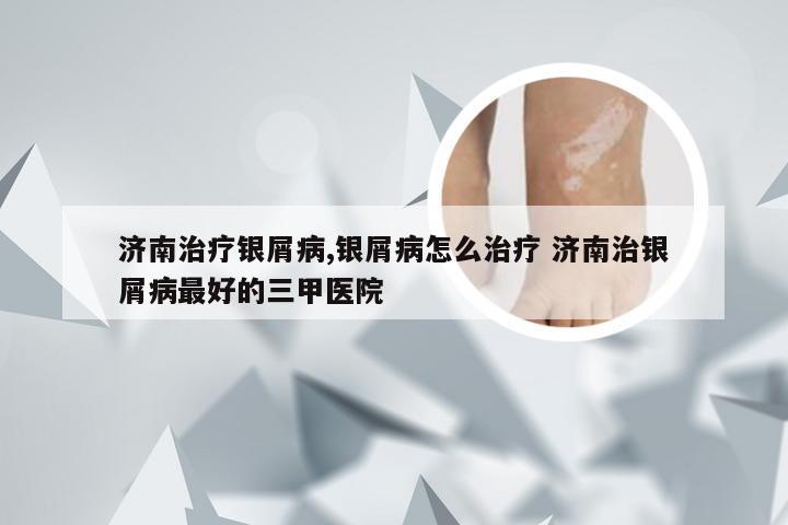 济南治疗银屑病,银屑病怎么治疗 济南治银屑病最好的三甲医院