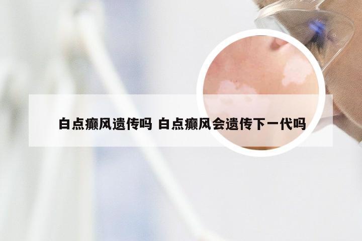 白点癫风遗传吗 白点癫风会遗传下一代吗
