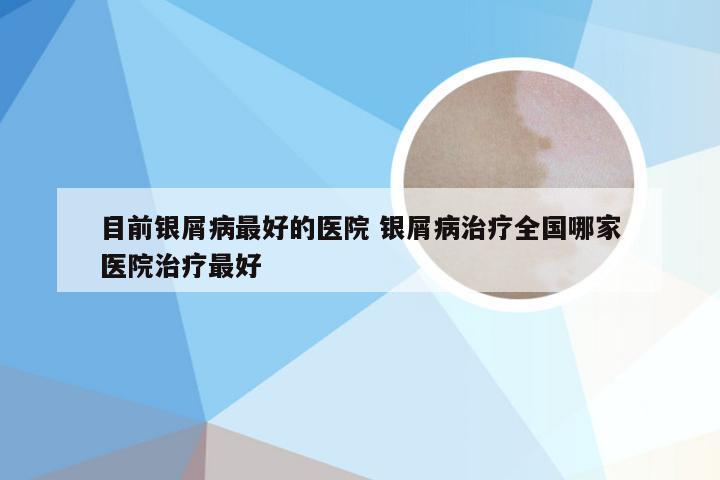 目前银屑病最好的医院 银屑病治疗全国哪家医院治疗最好