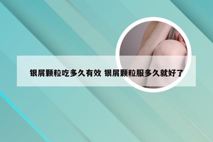银屑颗粒吃多久有效 银屑颗粒服多久就好了