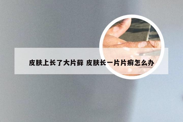 皮肤上长了大片藓 皮肤长一片片癣怎么办