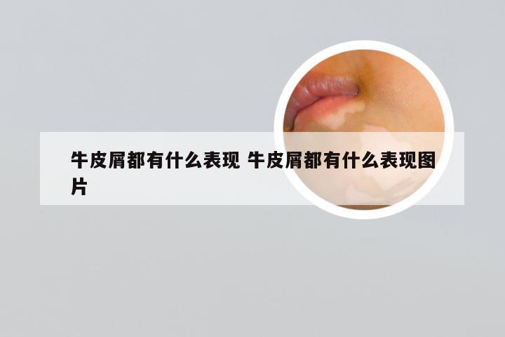 牛皮屑都有什么表现 牛皮屑都有什么表现图片