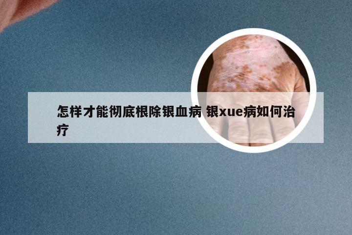 怎样才能彻底根除银血病 银xue病如何治疗