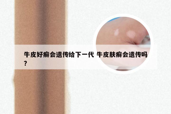 牛皮好癣会遗传给下一代 牛皮肤癣会遗传吗?