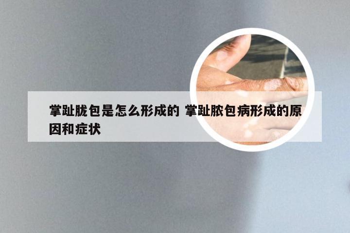 掌趾胧包是怎么形成的 掌趾脓包病形成的原因和症状