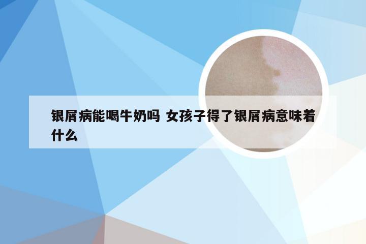 银屑病能喝牛奶吗 女孩子得了银屑病意味着什么