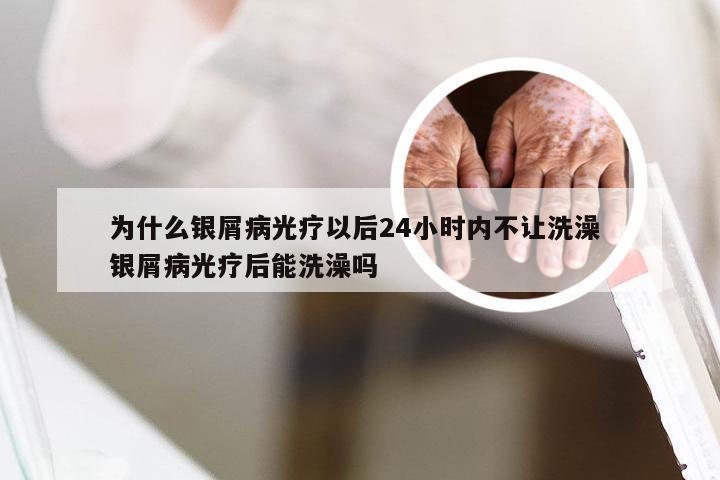 为什么银屑病光疗以后24小时内不让洗澡 银屑病光疗后能洗澡吗
