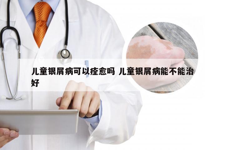 儿童银屑病可以痊愈吗 儿童银屑病能不能治好