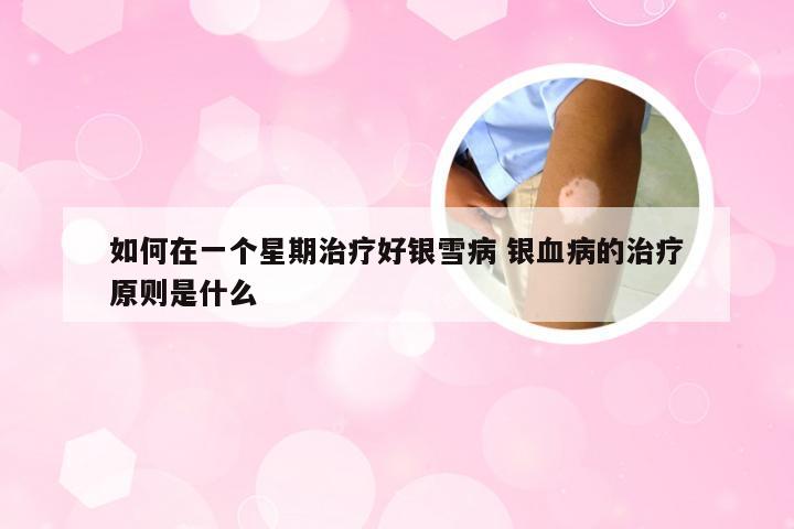 如何在一个星期治疗好银雪病 银血病的治疗原则是什么