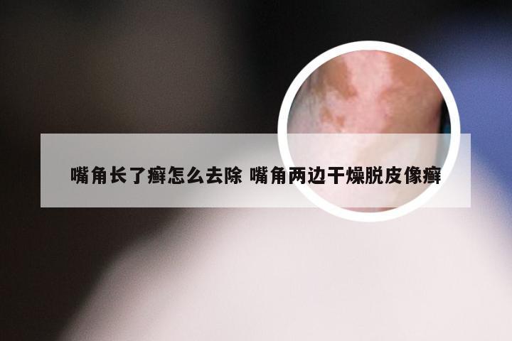 嘴角长了癣怎么去除 嘴角两边干燥脱皮像癣