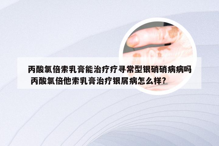 丙酸氯倍索乳膏能治疗疗寻常型银硝硝病病吗 丙酸氯倍他索乳膏治疗银屑病怎么样?