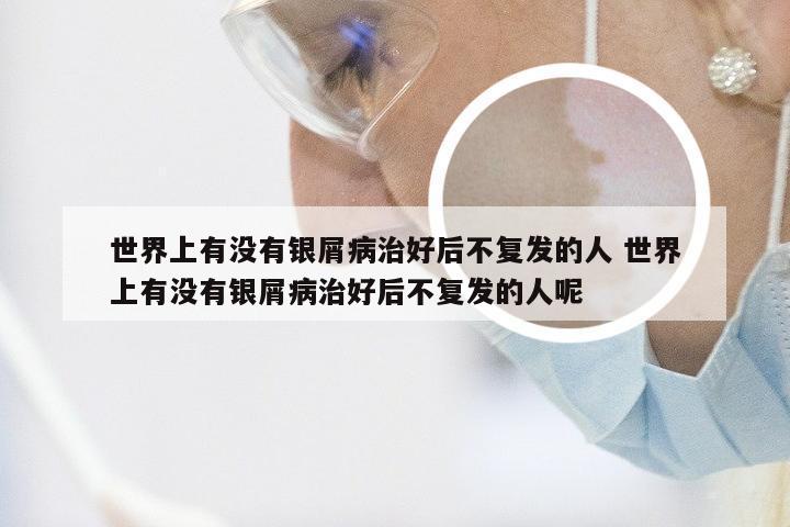 世界上有没有银屑病治好后不复发的人 世界上有没有银屑病治好后不复发的人呢