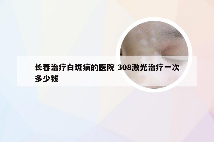 长春治疗白斑病的医院 308激光治疗一次多少钱