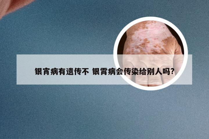 银宵病有遗传不 银霄病会传染给别人吗?