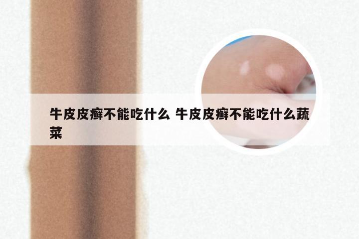 牛皮皮癣不能吃什么 牛皮皮癣不能吃什么蔬菜