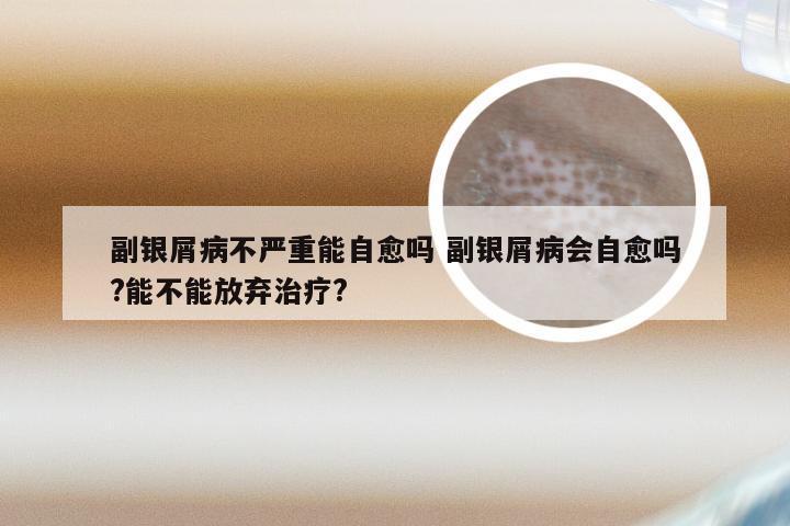 副银屑病不严重能自愈吗 副银屑病会自愈吗?能不能放弃治疗?
