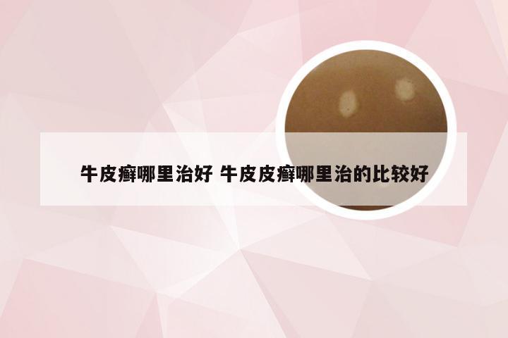 牛皮癣哪里治好 牛皮皮癣哪里治的比较好