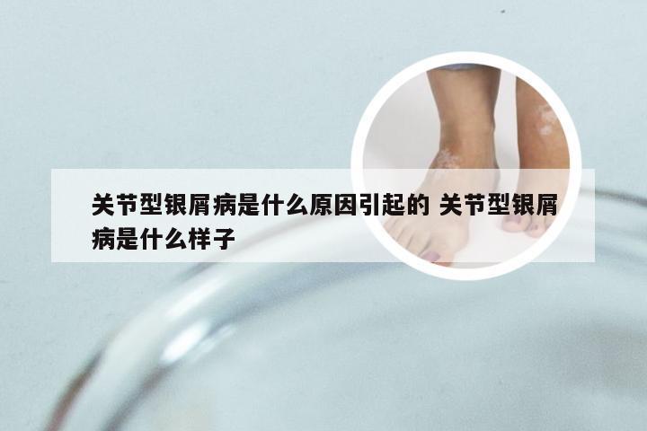关节型银屑病是什么原因引起的 关节型银屑病是什么样子
