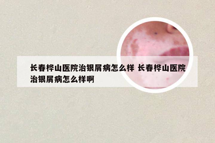 长春桦山医院治银屑病怎么样 长春桦山医院治银屑病怎么样啊