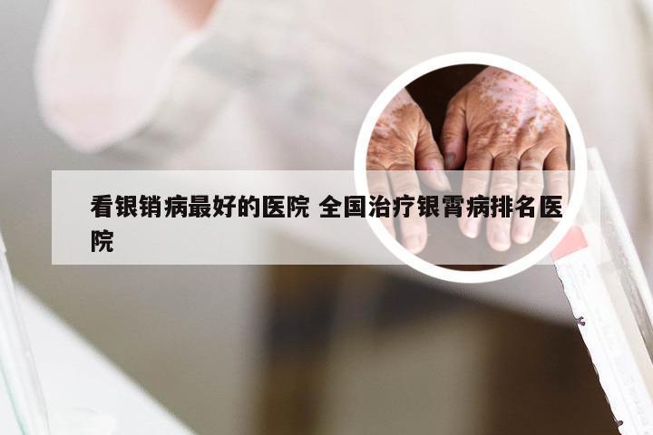 看银销病最好的医院 全国治疗银霄病排名医院