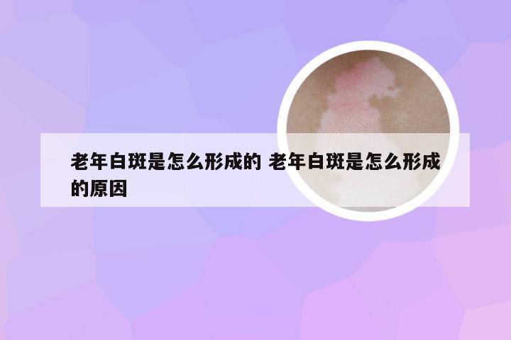 老年白斑是怎么形成的 老年白斑是怎么形成的原因