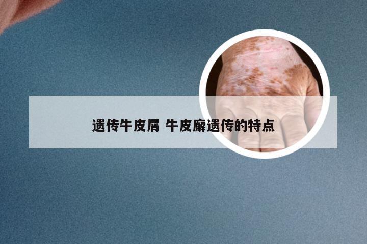 遗传牛皮屑 牛皮廨遗传的特点