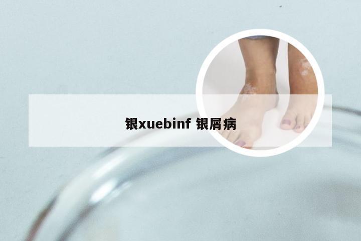 银xuebinf 银屑病